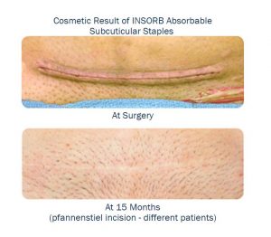 A comparison of the result of an insorb absorbable staple for a c-section. Comparison at surgery and 15 months later.